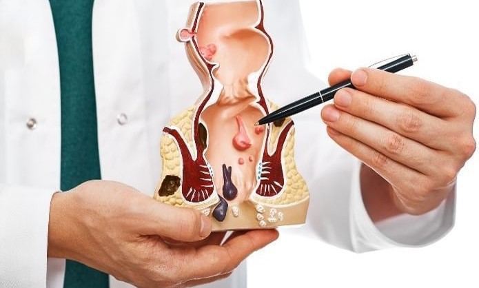 درمان بواسیر در طب اسلامی